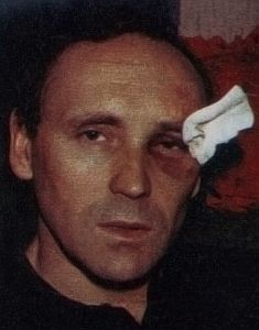 Posledice napada na Šurbekovom licu